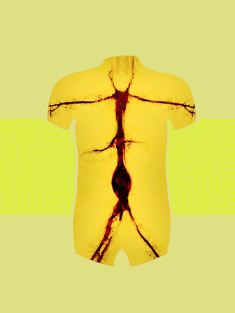 Aortic aneurysm (book cover artwork)