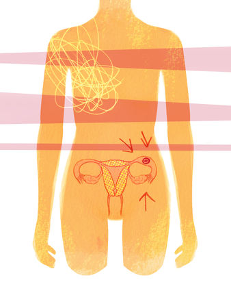 Ectopic pregnancy