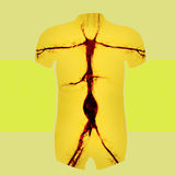 Aortic aneurysm (book cover artwork)