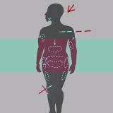 Liposuction